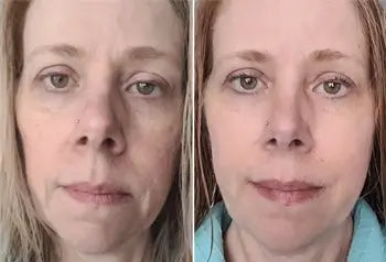 Before and After