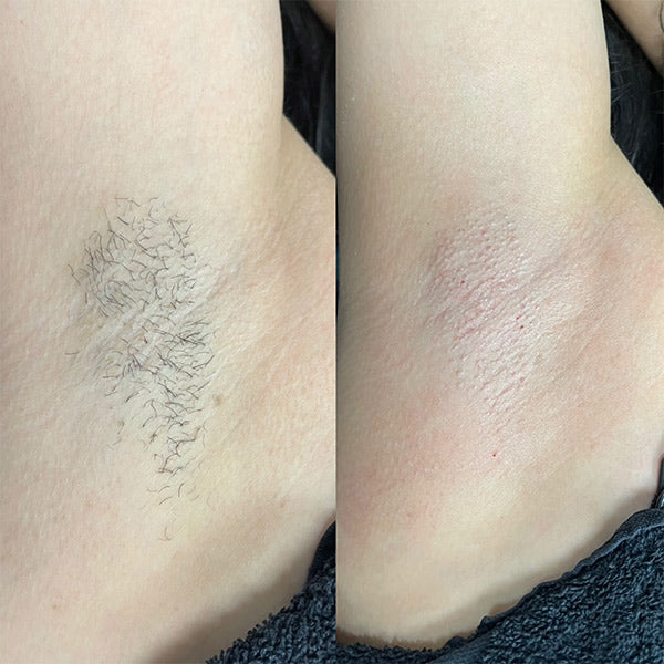 Before and after using Dermao IPL