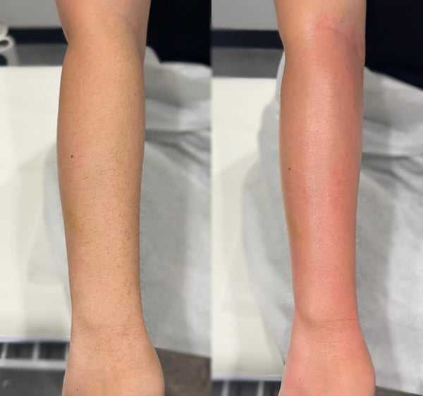 Before and after using Dermao IPL