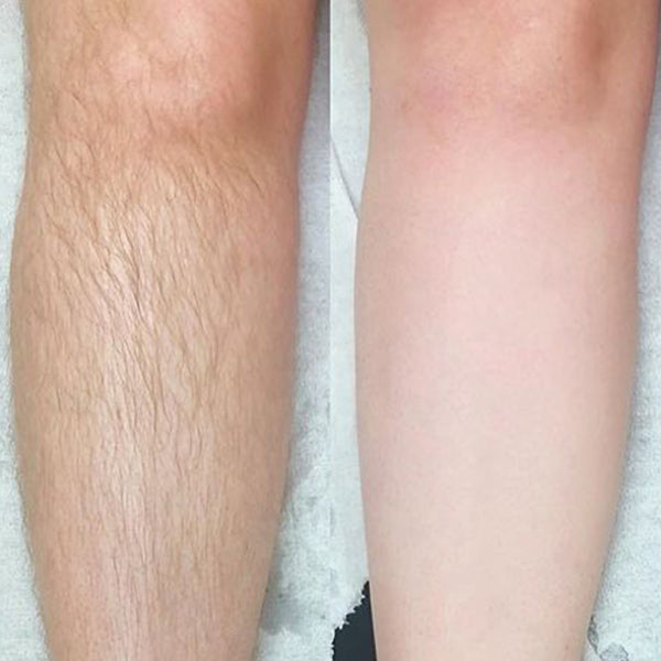 Before and after using Dermao IPL