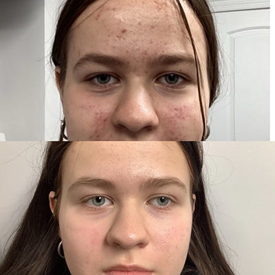 LED Mask Testimonial