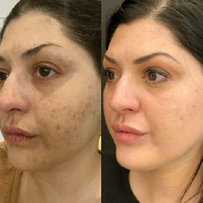 LED Mask Testimonial